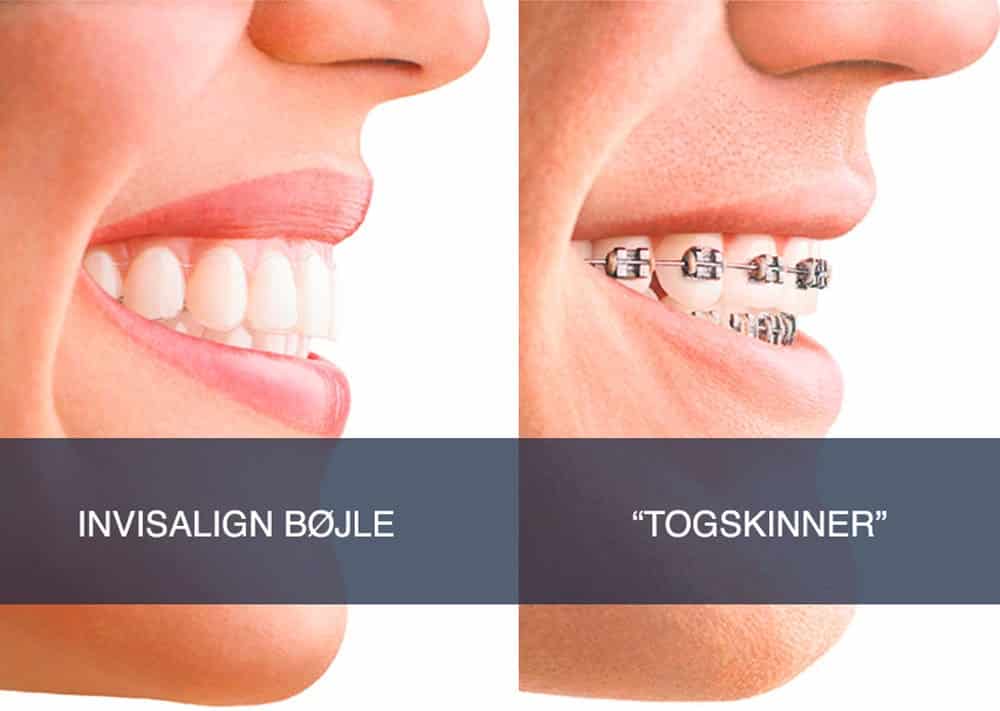invisalign-skinne